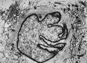 F, 49y. | myelosarcoma … histiocyte-like cells in dermal infiltrates F, 49y. | myelosarcoma … histiocyte-like cells in dermal infiltrates
